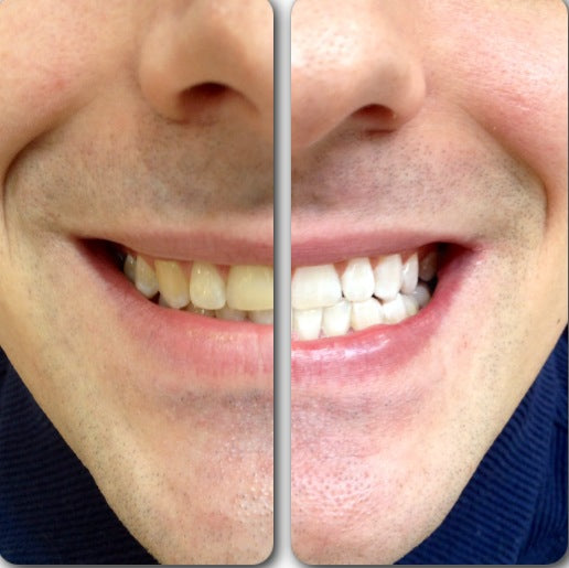Hismiles Teeth Brightening Serum