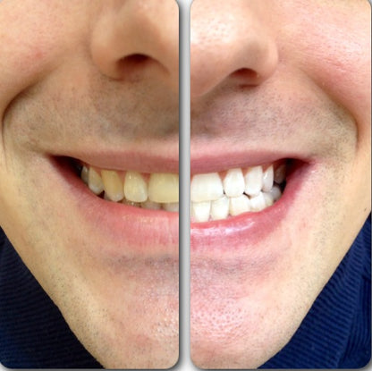 Hismiles Teeth Brightening Serum
