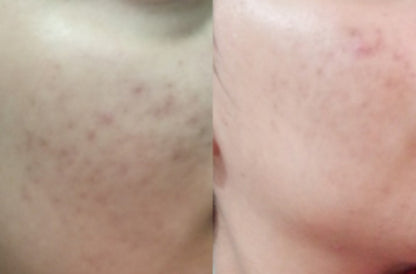 The Ordinary Niacinamide Serum 10% + Zinc 1% Supersize Serum
